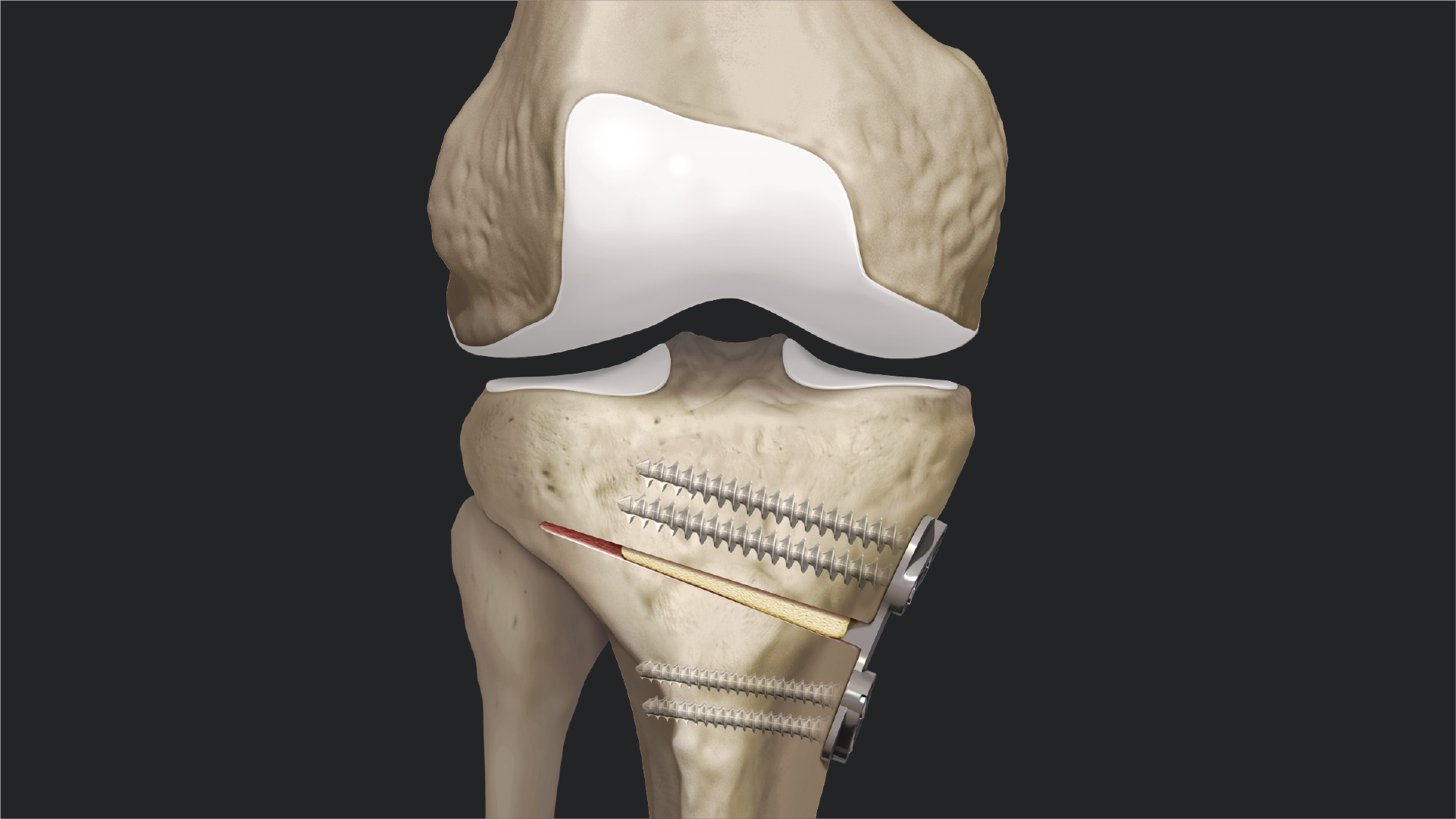 Robotic Surgery in Electronic City