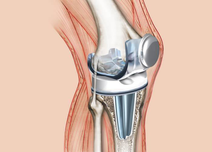 Robotic Surgery in Electronic City